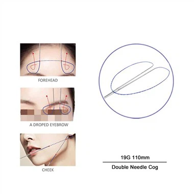 Double Needle Thread Lift